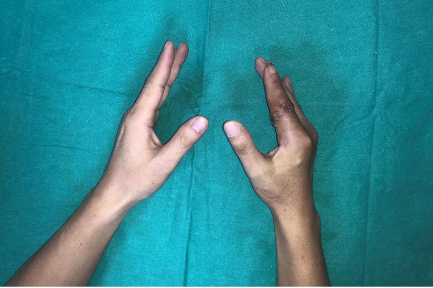 Lần đầu tiên bác sĩ Việt Nam vi phẫu thuật thành công 'cứu' ngón tay bệnh nhân đứt rời sau 25 giờ- Ảnh 2. Lần đầu tiên bác sĩ Việt Nam vi phẫu thuật thành công 'cứu' ngón tay bệnh nhân đứt rời sau 25 giờ- Ảnh 2.