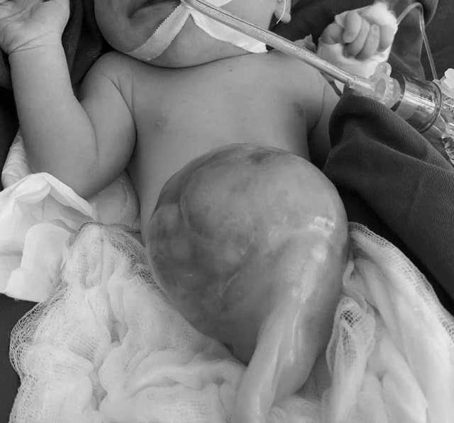 Cứu sống trẻ sơ sinh có gan, ruột nằm ngoài ổ bụng- Ảnh 1. Cứu sống trẻ sơ sinh có gan, ruột nằm ngoài ổ bụng- Ảnh 1.