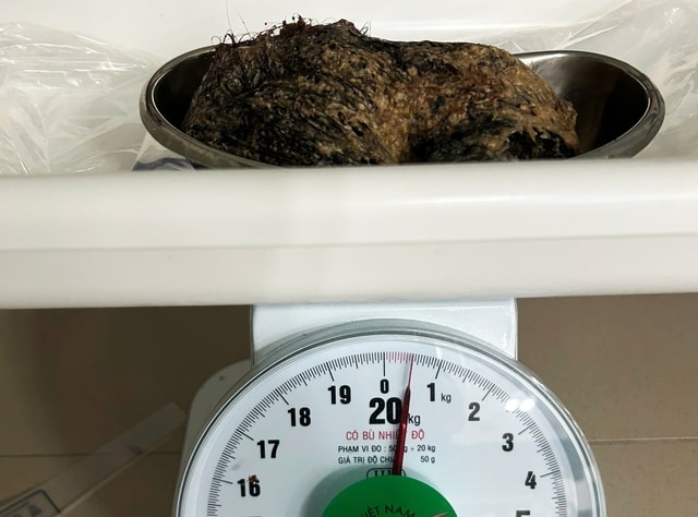 Nửa cân tóc trong dạ dày bé gái 6 tuổi - Ảnh 2.