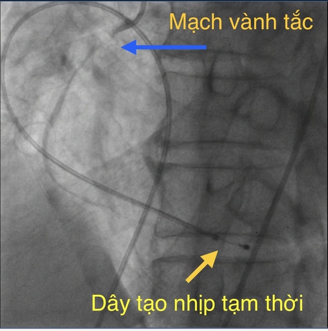 Cứu sống bệnh nhân 70 tuổi vì nhầm nhồi máu cơ tim với 'trúng gió'- Ảnh 1. Cứu sống bệnh nhân 70 tuổi vì nhầm nhồi máu cơ tim với 'trúng gió'- Ảnh 1.