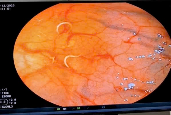 Ổ giun trong đại tràng người phụ nữ có thói quen ăn rau sống- Ảnh 2.