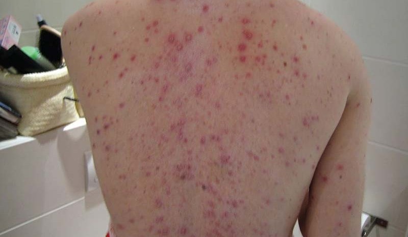 Nguy cơ biến chứng thủy đậu từ việc dùng thuốc sai cách- Ảnh 1. Nguy cơ biến chứng thủy đậu từ việc dùng thuốc sai cách- Ảnh 1.