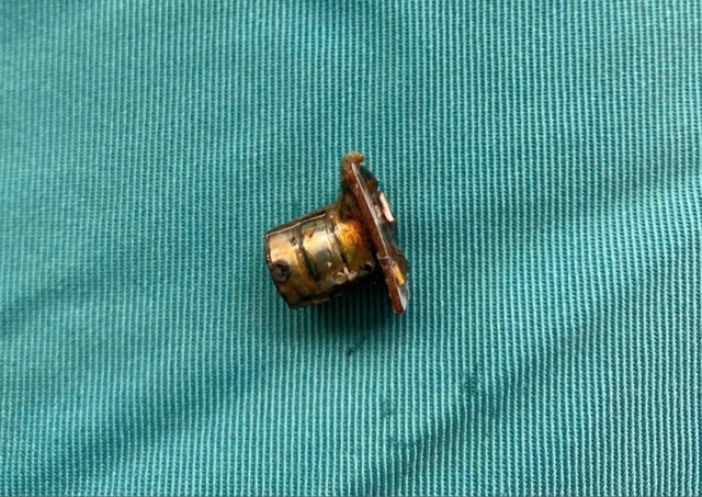 Cụm pin cúc áo trong thực quản bé trai 2 tuổi- Ảnh 2.