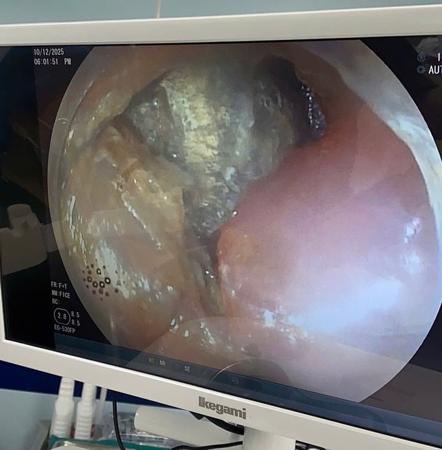 Cụm pin cúc áo trong thực quản bé trai 2 tuổi- Ảnh 1.