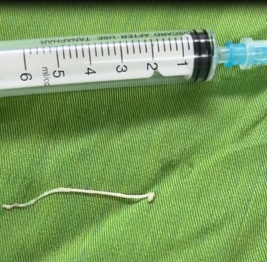 Phẫu thuật khối u, phát hiện ký sinh trùng dạng sán trong vùng hố chậu bệnh nhân- Ảnh 1.