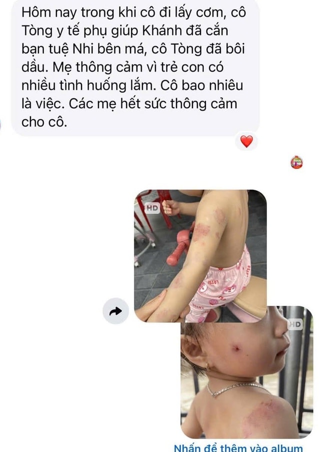 Bé mầm non bị nhiều vết cắn, bầm tím sau giờ học khiến phụ huynh bức xúc- Ảnh 2.