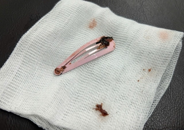 Bé 6 tuổi nhập viện cấp cứu vì nuốt kẹp tóc kim loại- Ảnh 1.