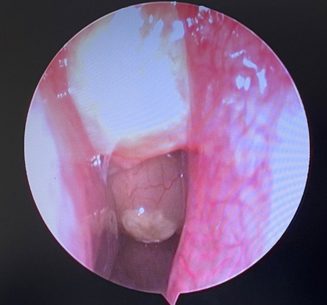 Phẫu thuật thành công cho bệnh nhân polyp mũi hai bên, viêm mũi xoang kèm hàng loạt bệnh lý nền nặng - Ảnh 1.
