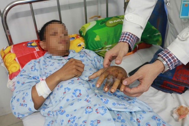 Bệnh viện tuyến tỉnh cứu sống nam thanh niên bị rắn cực độc cắn nguy kịch- Ảnh 1.