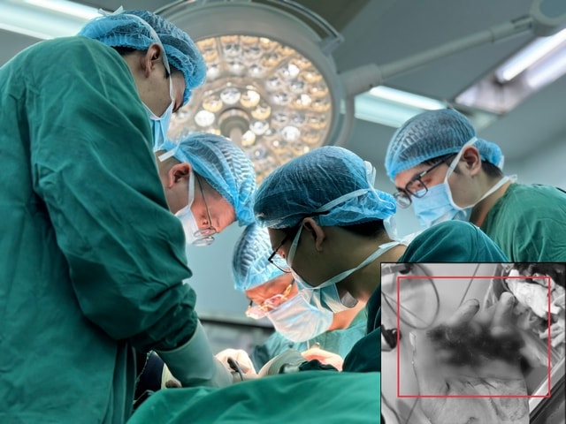 Nối thành công 4 ngón tay gần đứt rời cho bệnh nhân 25 tuổi- Ảnh 2.