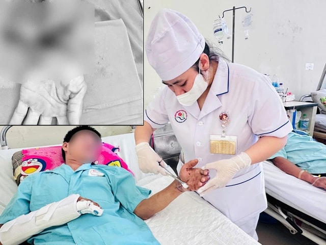 Nối thành công cổ tay đứt lìa: Ca vi phẫu 8 giờ xuyên đêm giành lại cơ thể trọn vẹn cho người bệnh- Ảnh 2.
