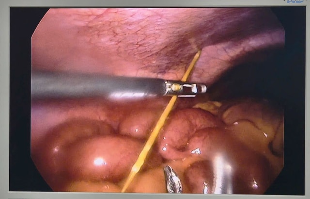 Thủng ruột do thói quen rất nhiều người mắc- Ảnh 1.