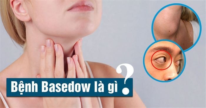 Khi bị basedow có phải kiêng iod không?- Ảnh 1.