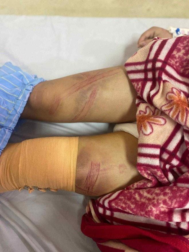 Nữ sinh lớp 7 ở Nghệ An nghi bị bố đánh bầm tím khắp người- Ảnh 1.