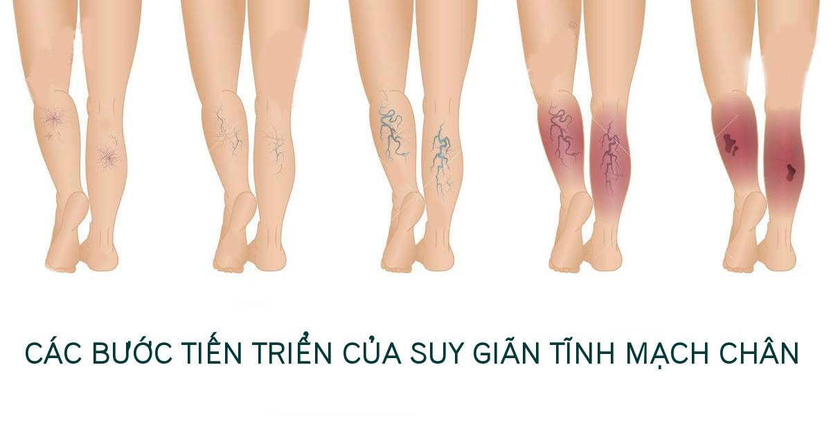 Thuốc và phương pháp điều trị suy tĩnh mạch chi dưới mạn tính- Ảnh 1.