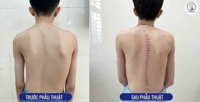 Phẫu thuật Cột sống tại Bệnh viện Chấn thương Chỉnh hình Nghệ An: Đột phá chuyên môn và phát triển vượt bậc- Ảnh 3.