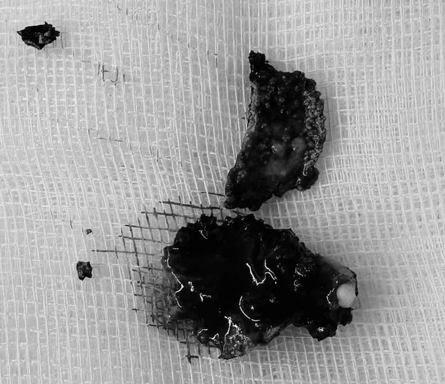 Bác sĩ lấy dị vật vôi hóa tồn tại nhiều năm trong mũi bệnh nhân- Ảnh 2.