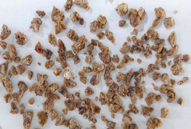 Sỏi được các bác sĩ phẫu thuật lấy ra khỏi thận người bệnh.