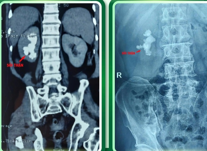 Phẫu thuật thành công ca sỏi san hô phức tạp trên nền xơ gan- Ảnh 2.