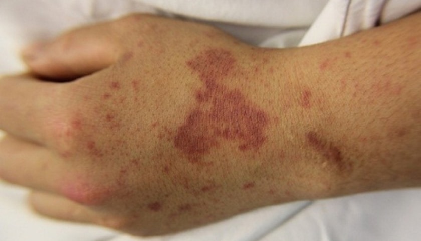 Chuyên gia khuyên gì về căn bệnh truyền nhiễm có thể gây tử vong trong 24h?- Ảnh 2.