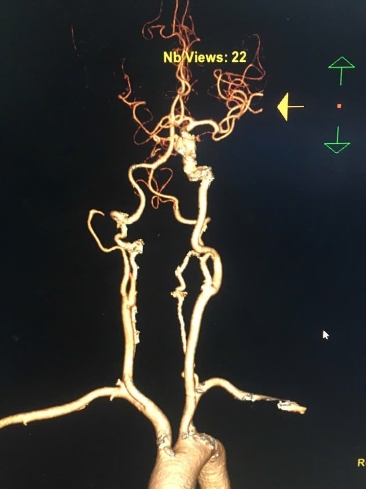Cứu cụ bà 75 tuổi đột quỵ nhồi máu não thoát lằn ranh sinh tử- Ảnh 1.