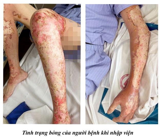 Bỏng nặng khi đốt sofa cũ, người đàn ông vào viện cấp cứu- Ảnh 1. Bỏng nặng khi đốt sofa cũ, người đàn ông vào viện cấp cứu- Ảnh 1.