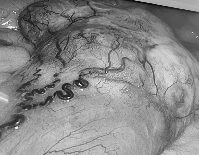 Một bệnh nhân cùng lúc phát hiện mắc 2 khối u ác tính- Ảnh 1.