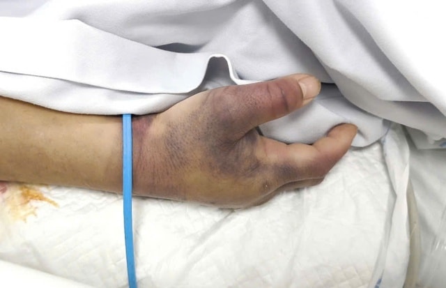 Sốt xuất huyết diễn biến nguy kịch ở bệnh nhân có nhiều bệnh nền- Ảnh 1.