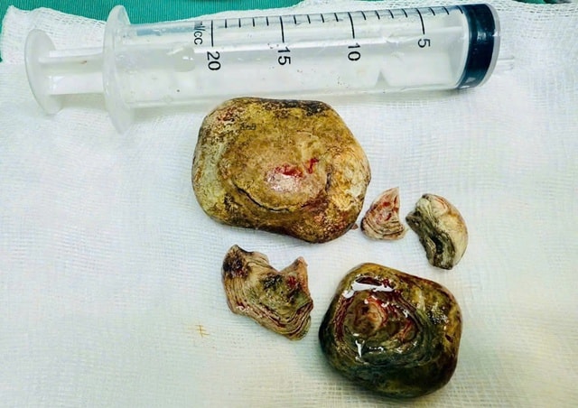 Phẫu thuật khối sỏi bàng quang kích thước lớn cho bệnh nhân mắc nhiều bệnh lý nền- Ảnh 1.