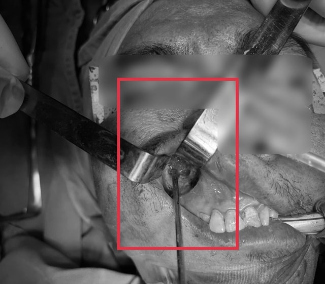 Nấm đen 'ăn' mòn xoang hàm người đàn ông khỏe mạnh- Ảnh 2.