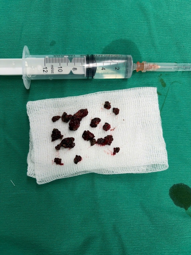 Nấm đen 'ăn' mòn xoang hàm người đàn ông khỏe mạnh- Ảnh 3.