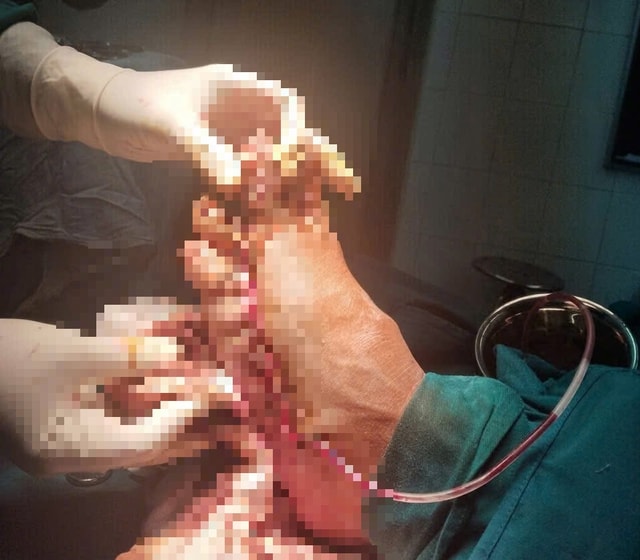 Người đàn ông suýt mất bàn chân vì máy cắt cỏ- Ảnh 1.