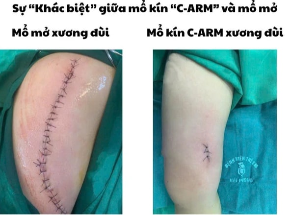 Bệnh viện Nhi Hải Phòng ứng dụng kỹ thuật C-arm trong phẫu thuật gãy xương trẻ em - Ảnh 1.
