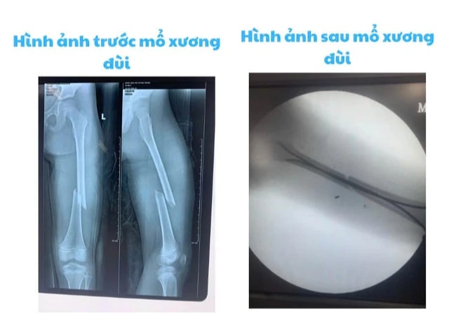 Bệnh viện Nhi Hải Phòng ứng dụng kỹ thuật C-arm trong phẫu thuật gãy xương trẻ em - Ảnh 2.