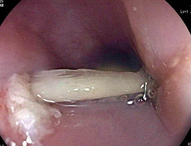 Liên tiếp ca mắc dị vật nguy hiểm, bác sĩ cảnh báo nguy cơ đe dọa tính mạng- Ảnh 3.