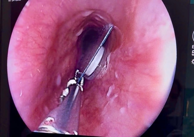 Liên tiếp ca mắc dị vật nguy hiểm, bác sĩ cảnh báo nguy cơ đe dọa tính mạng- Ảnh 1.