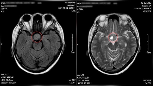 Nhìn mờ kéo dài, người phụ nữ phát hiện u tuyến yên nhờ khám mắt- Ảnh 1. Nhìn mờ kéo dài, người phụ nữ phát hiện u tuyến yên nhờ khám mắt- Ảnh 1.