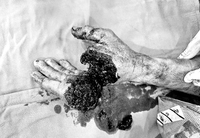 Cứu bàn tay gần lìa của nam công nhân bị máy cưa gỗ cắt- Ảnh 1.