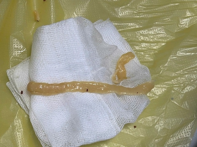 Người đàn ông hay ăn đồ sống và tiết canh, nhiễm sán dây gần 1m- Ảnh 1.