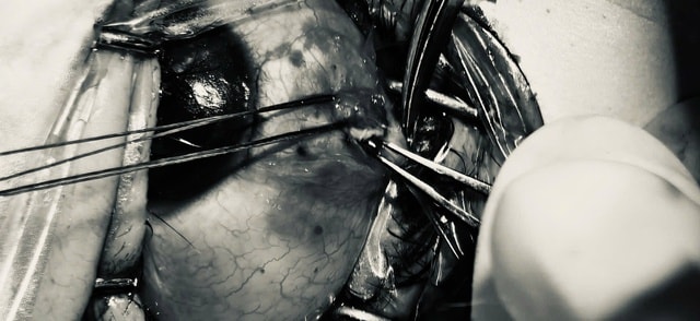 Bảo tồn nhãn cầu cho bệnh nhân bị đinh sắt bắn vào mắt- Ảnh 1.