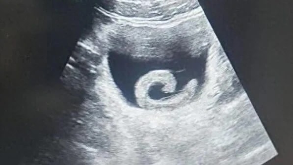 Người đàn ông phải nhập viện cấp cứu vì… đỉa sống trong bàng quang- Ảnh 1.