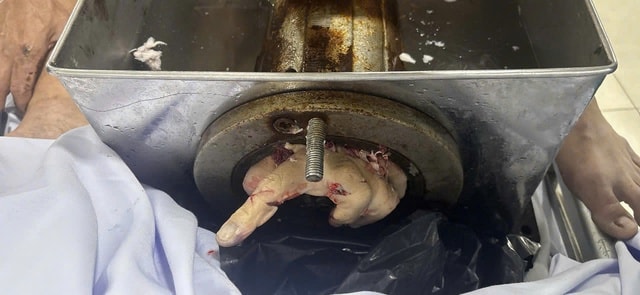 Bị máy xay thịt cuốn tay, nam công nhân bị cắt cụt tới 1/3 trên cẳng tay- Ảnh 1.