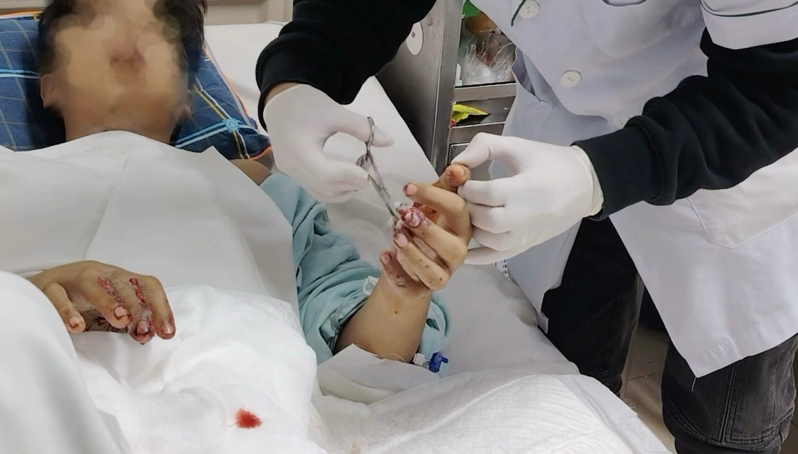 Trẻ 15 tuổi bị biến dạng khuôn mặt, tổn thương nghiêm trọng do tai nạn pháo nổ- Ảnh 2.