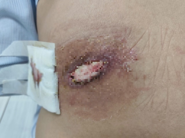 Người phụ nữ bị hoại tử lưng vì điều trị mụn nhọt theo phương pháp truyền miệng- Ảnh 1.