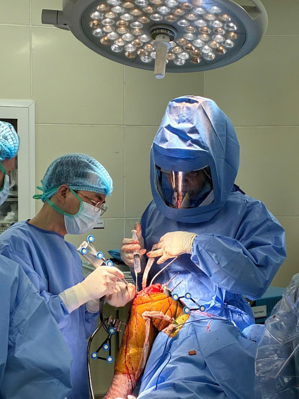 Lần đầu tiên ứng dụng robot hiện đại phẫu thuật thay khớp gối toàn phần thành công- Ảnh 3.