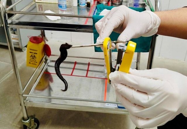 Đỉa dài 10 cm sống ký sinh trong mũi người bệnh- Ảnh 1.