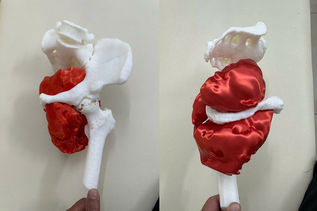 Cứu sống bệnh nhân ung thư hiếm gặp bằng phẫu thuật tháo nửa khung chậu- Ảnh 1.