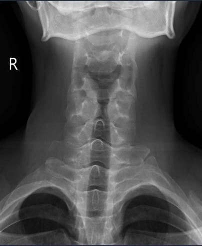 Đau cột sống cổ âm ỉ 5 tháng, nam thanh niên 26 tuổi phát hiện viêm cột sống dính khớp- Ảnh 1. Đau cột sống cổ âm ỉ 5 tháng, nam thanh niên 26 tuổi phát hiện viêm cột sống dính khớp- Ảnh 1.
