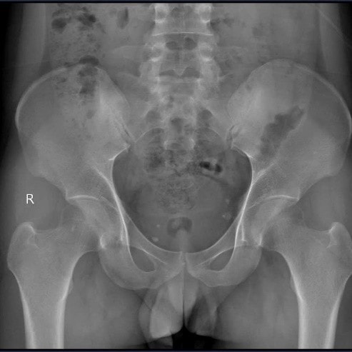 Đau cột sống cổ âm ỉ 5 tháng, nam thanh niên 26 tuổi phát hiện viêm cột sống dính khớp- Ảnh 2. Đau cột sống cổ âm ỉ 5 tháng, nam thanh niên 26 tuổi phát hiện viêm cột sống dính khớp- Ảnh 2.