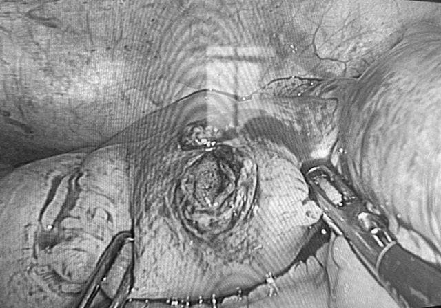 Phẫu thuật nội soi cấp cứu thành công cho nam thanh niên bị đinh xuyên thủng ruột non - Ảnh 1.